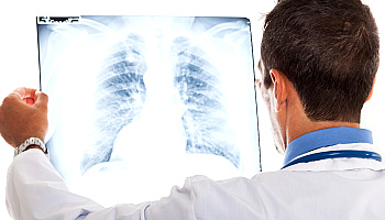 Diagnoza: Rak płuca